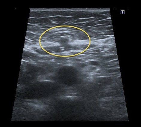 How are hernias diagnosed?